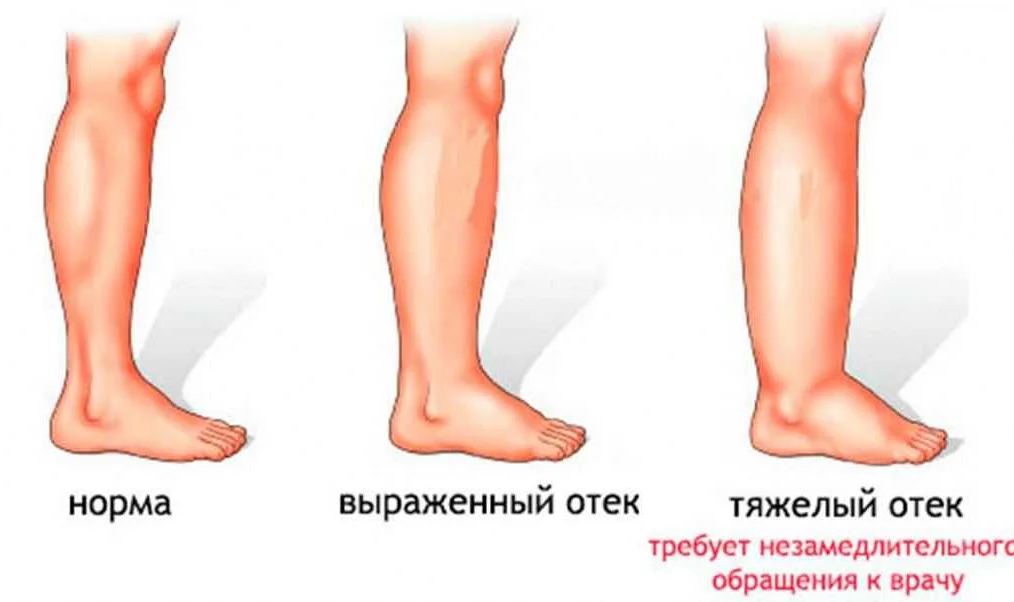 Как предотвратить отеки при физической нагрузке полезные советы