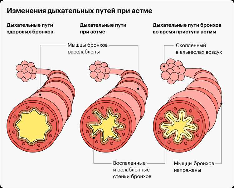 Почему возникает кашель при физической нагрузке и как справиться с этим неприятным симптомом