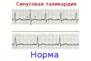 Статья — Тахикардия при физической нагрузке — какие симптомы сигнализируют о проблеме, какие причины лежат в основе этого состояния и какое лечение поможет вернуть сердце к нормальному ритму